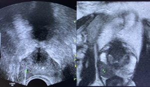 Biopsia próstata com fusão