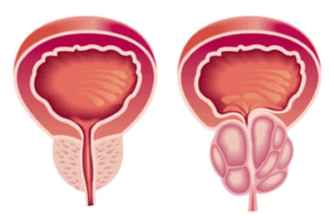 Hiperplasia Prostática