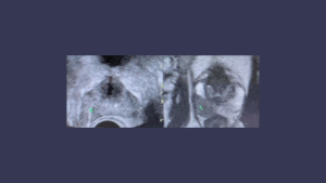 Biópsia Próstata de Fusão