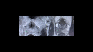 Biópsia Próstata com Fusão