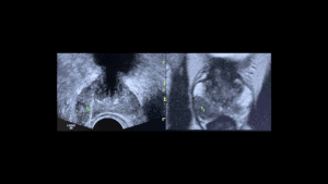 Biópsia Próstata com Fusão