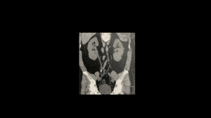 Cálculos Urinários