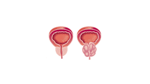 Hiperplasia Prostática